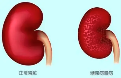 跨器官无创评估:高级声衰减开拓代谢病检测新场景(图6) 94515deca43ca1d8acbb36ad439e775c.png