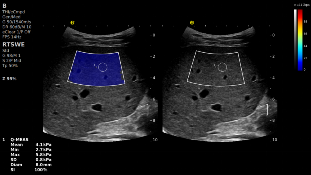 别等肝受损！E超“四道防线”精准守肝(图2)