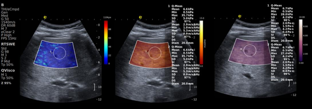 别等肝受损！E超“四道防线”精准守肝(图1)
