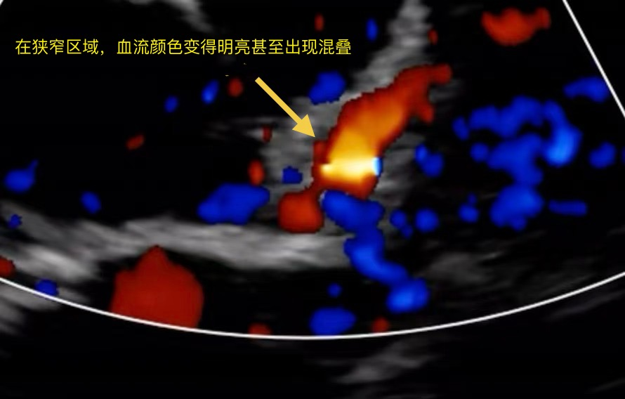 从近期“心源性猝死”高发看健康危机，您的冠脉还好吗？(图28)