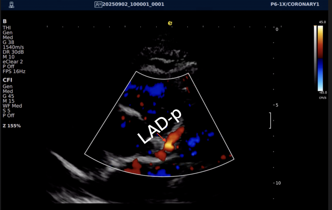从近期“心源性猝死”高发看健康危机，您的冠脉还好吗？(图23)